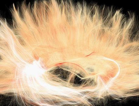 a white and cream-colored, domelike array of ultrafine fibers in the brain, captured by a specialized imaging technique