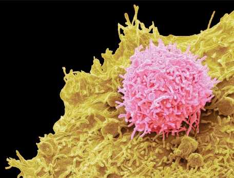 A colorized scanning electron micrograph shows a T-cell (pink) that has been modified to target cancer cells