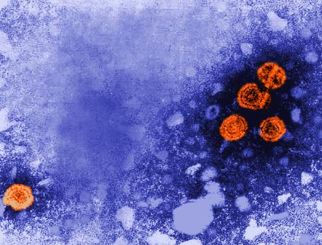Transmission electron microscope image showing spherical Hepatitis B virus particles, highlighted in orange, against a textured blue background. The contrast coloring highlights the viral particles dispersed in the field, with a cluster of four particles on the right and a single particle on the left.