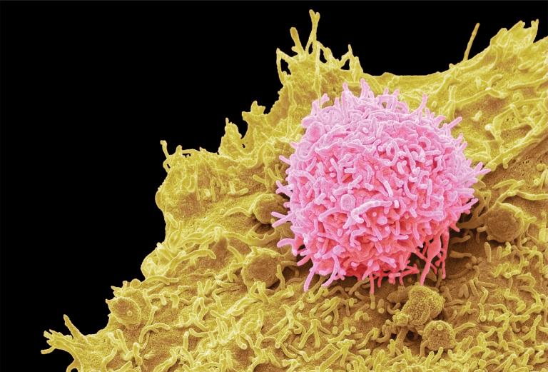 A colorized scanning electron micrograph shows a T-cell (pink) that has been modified to target cancer cells