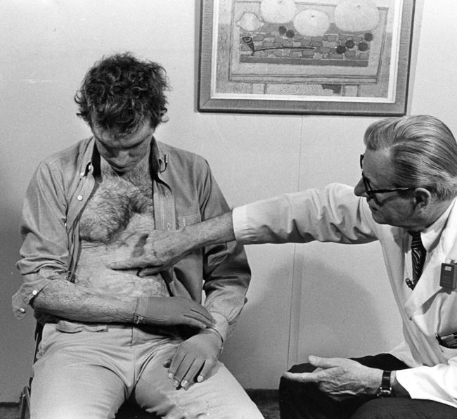 John Burke points to an area of a patient’s abdomen that had been severely burned but was repaired using Burke’s artificial skin product.