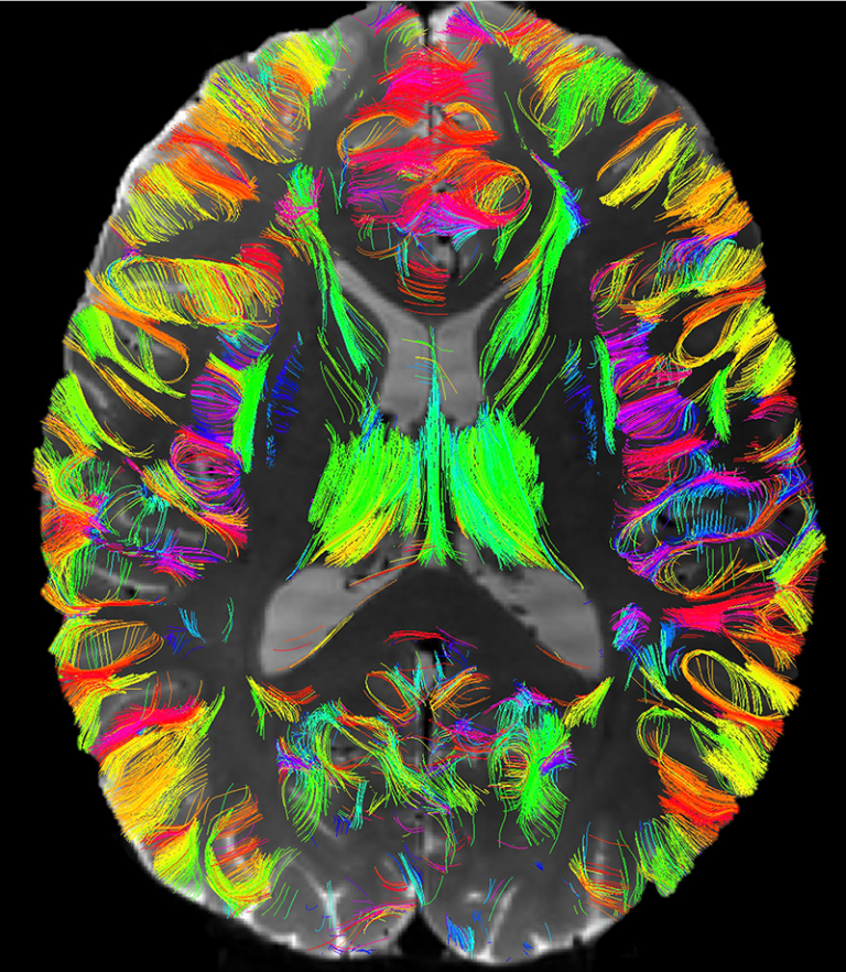 An image of the white matter of the brain with its many connections highlighted in different colors