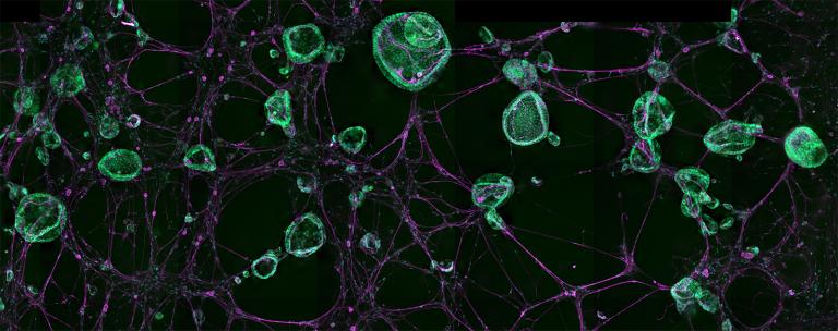 Microsopy image of tumeroids and neurons forming connections.