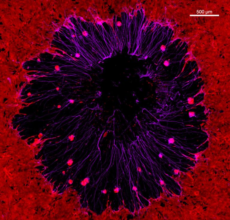 Microscopy image of nerve fibers and tumor cells