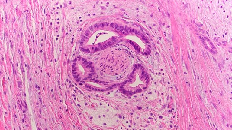 A tissue slide of pancreatic cancer