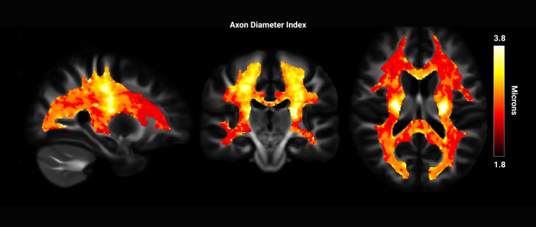 Three brain scans showing axon diameter index with a color gradient from red to yellow, alongside a microns scale.