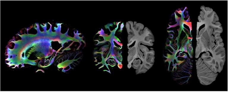 Colored and grayscale cross-sectional images of a human brain highlighting neural pathways and structures.