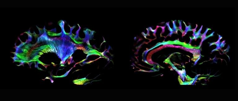 Two colorful brain scans on a black background, showing cross-sectional and profile views with intricate, multicolored patterns.