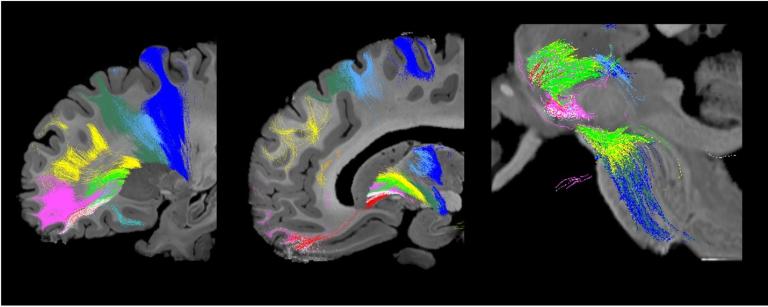 Sagittal brain scans with colorful overlays showing neural pathways.